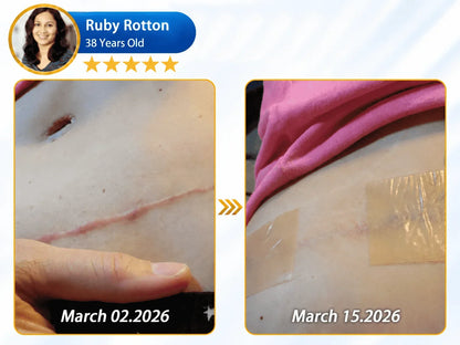 🔥 𝐎𝐟𝐟𝐢𝐜𝐢𝐚𝐥 𝐒𝐭𝐨𝐫𝐞丨Dr.Fachmer® 🩹 Bio-Regenerative Microneedle Scar Tape——Remove all kinds of skin scars